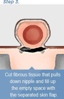 유두를 밑으로 당기는 섬유조직을 절단 후, 박리된 피판으로 빈 공간을 채워줌