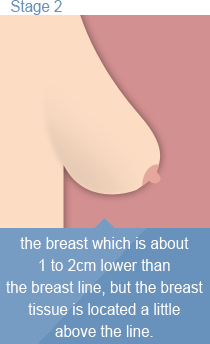 유두가 가슴 밑 주름보다 1~3cm 정도 내려가 있지만 가슴조직의 가장 아래보다는 위에 있는 경우